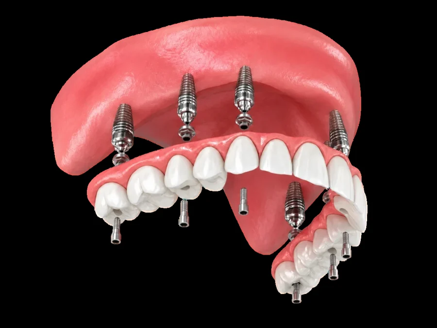Illustration of a full arch of teeth supported by dental implants