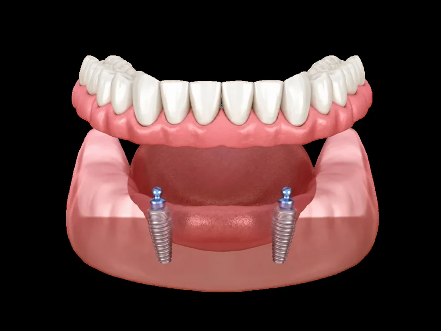 Illustration of snap-on dentures attached to dental implants