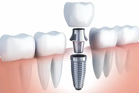 Dental Implants in Arvada, CO