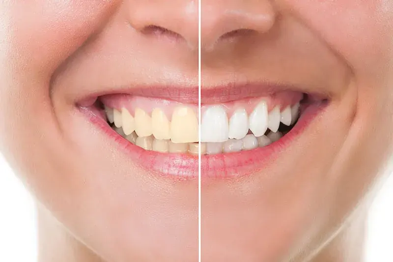 Veneers in Arvada, CO
