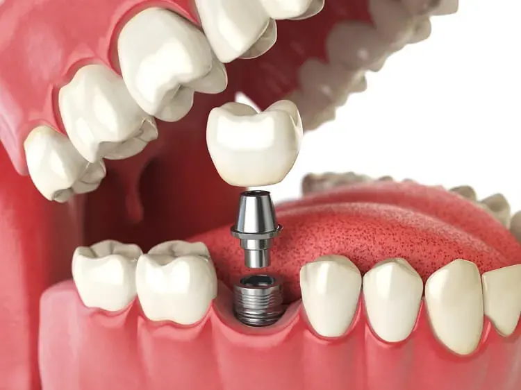 Dental implant illustration