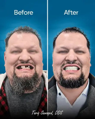 Before and after smile transformation, result 8