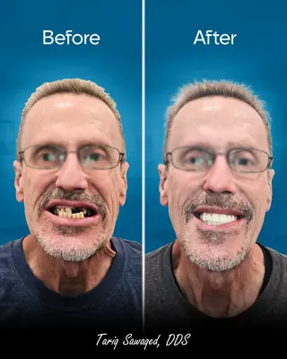 Before and after smile transformation, result 10