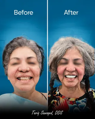 Before and after smile transformation, result 11