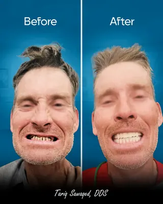 Before and after smile transformation, result 13