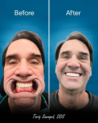 Before and after smile transformation, result 12