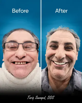 Before and after smile transformation, result 6