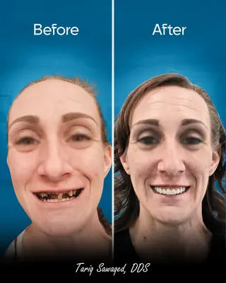 Before and after smile transformation, result 5