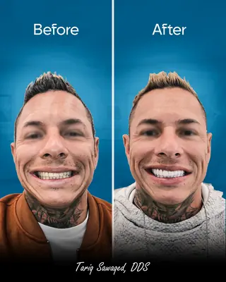 Before and after smile transformation, result 4