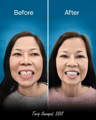 Before and after smile transformation of a woman