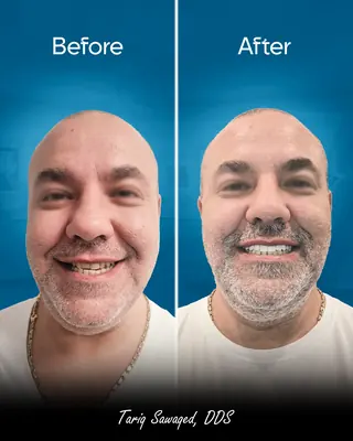 Before and after smile transformation of a man