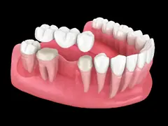 Multiple Missing Teeth