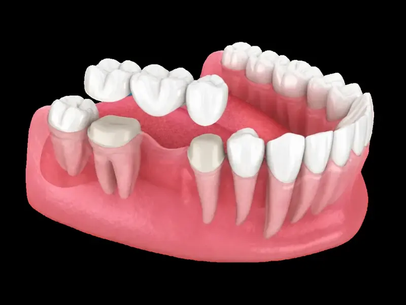 Multiple Missing Teeth in Arvada, CO