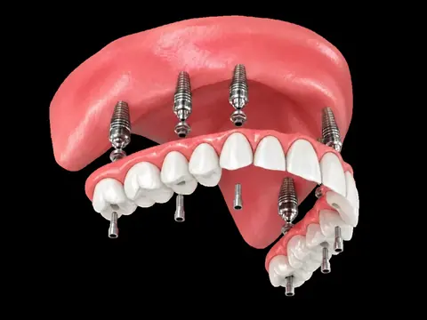 All-on-X full-arch dental implants