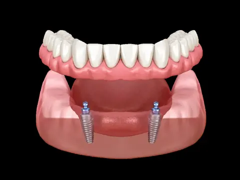 Snap-On Dentures in Arvada, CO
