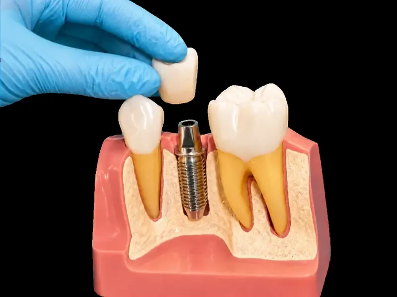 One Missing Tooth in Arvada, CO